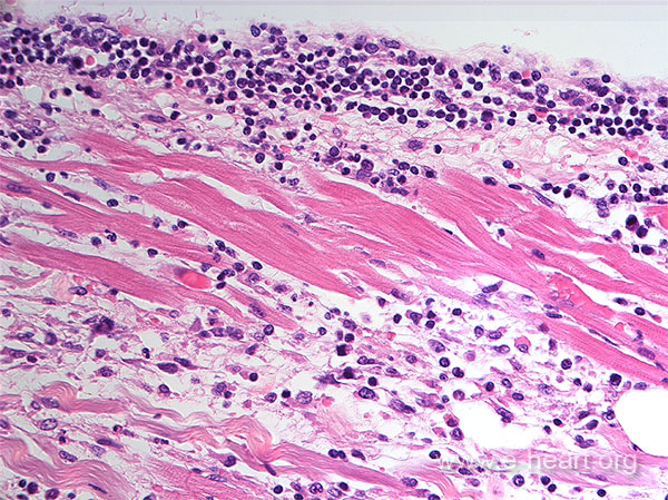 Endocardial severe rejection 01